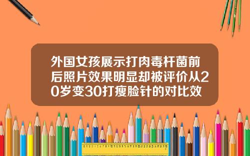 外国女孩展示打肉毒杆菌前后照片效果明显却被评价从20岁变30打瘦脸针的对比效果图片