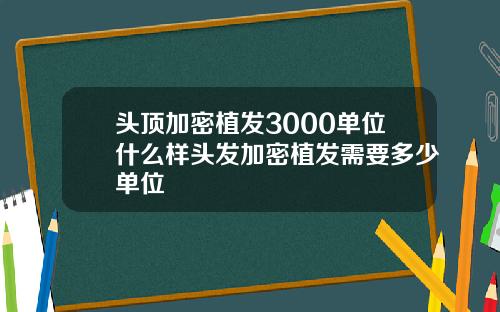 头顶加密植发3000单位什么样头发加密植发需要多少单位