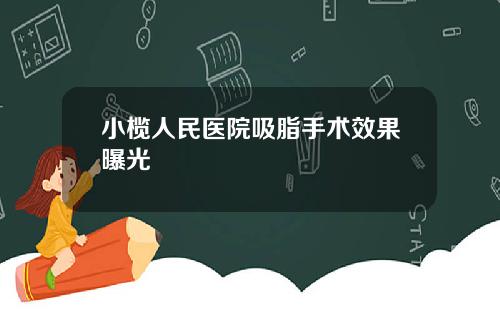 小榄人民医院吸脂手术效果曝光