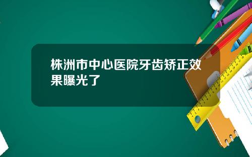 株洲市中心医院牙齿矫正效果曝光了