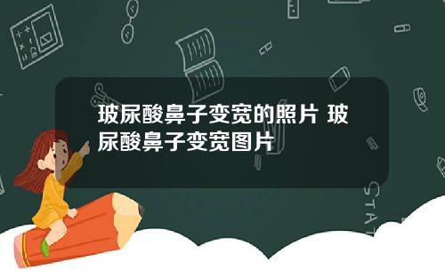 玻尿酸鼻子变宽的照片 玻尿酸鼻子变宽图片