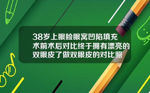 38岁上眼睑眼窝凹陷填充术前术后对比终于拥有漂亮的双眼皮了做双眼皮的对比照